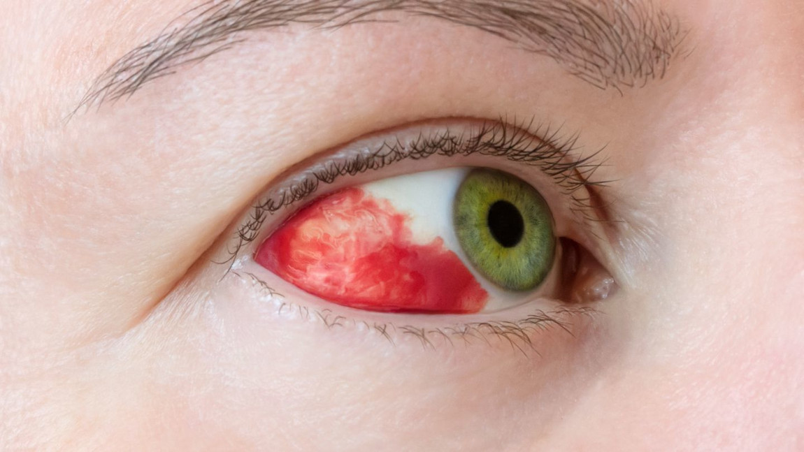 Лечение кровоизлияние в глаз после инсульта