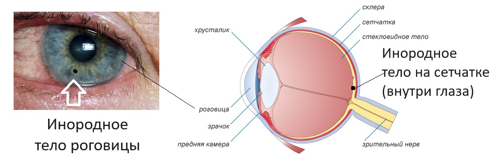 Близорукость после попадания инородного тела в глаз