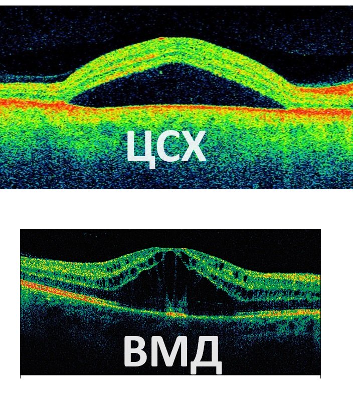 Лечение ЦСХ (центральной серозной хориоретинопатии) без лазерной операции