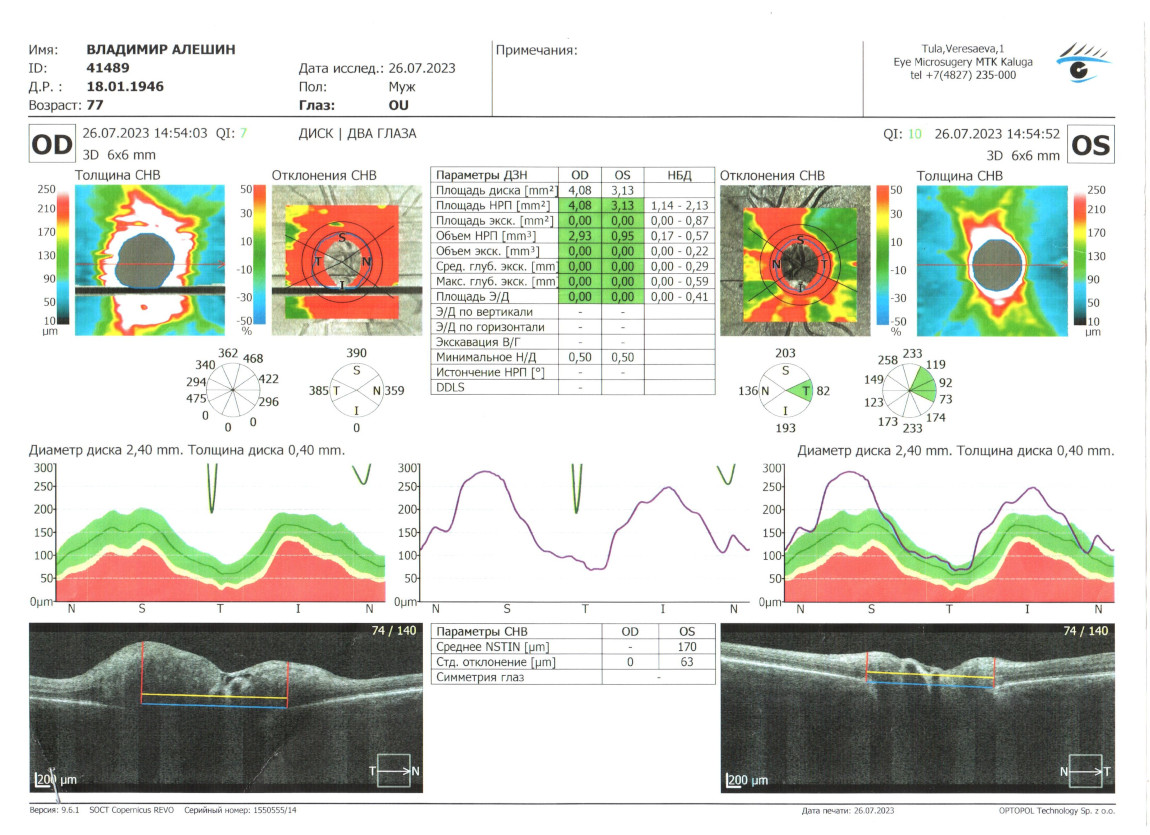 ОКТ (оптическая когерентная томография) диска зрительного нерва до лечения очками Панкова и Сидоренко