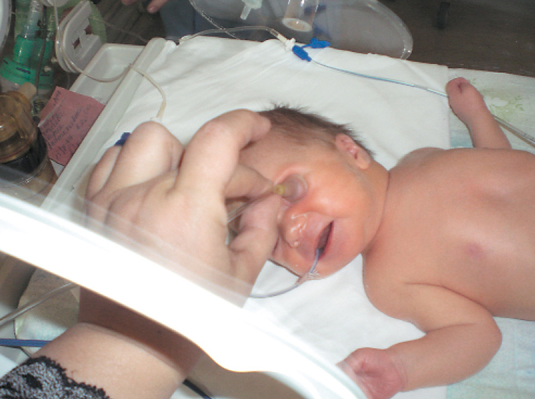 Проведение инфразвукового вакуумного пневмомассажа недоношенному ребенку в условиях кувеза