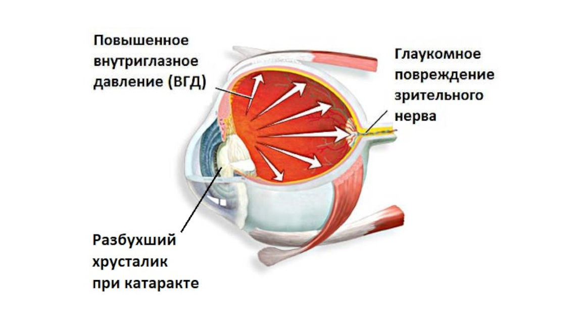 Застарелая катаракта и глаукома - лечение