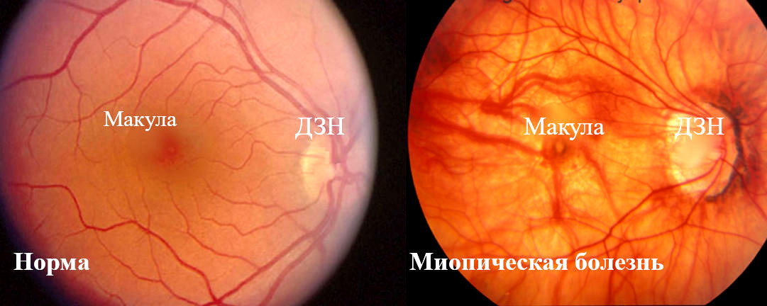  Картина глазного дна при злокачественной близорукости (миопической болезни)